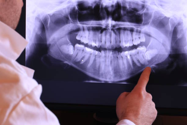 Best Urgent Care for Lost Fillings or Crowns in Yarrow Point, WA